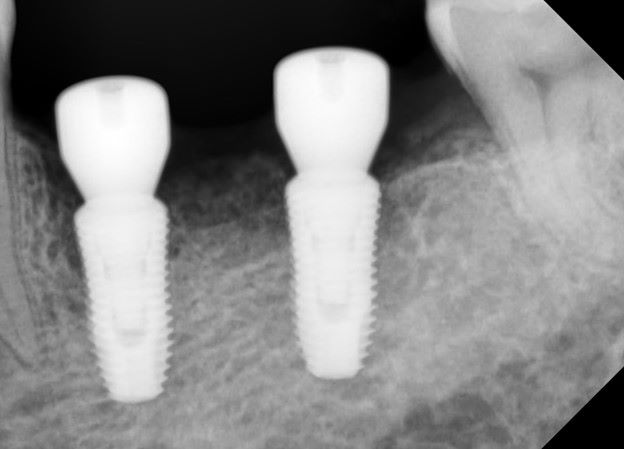 obyazatelno-li-stavit-vremennuyu-koronku-na-implant.jpg